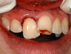 tooth luxation