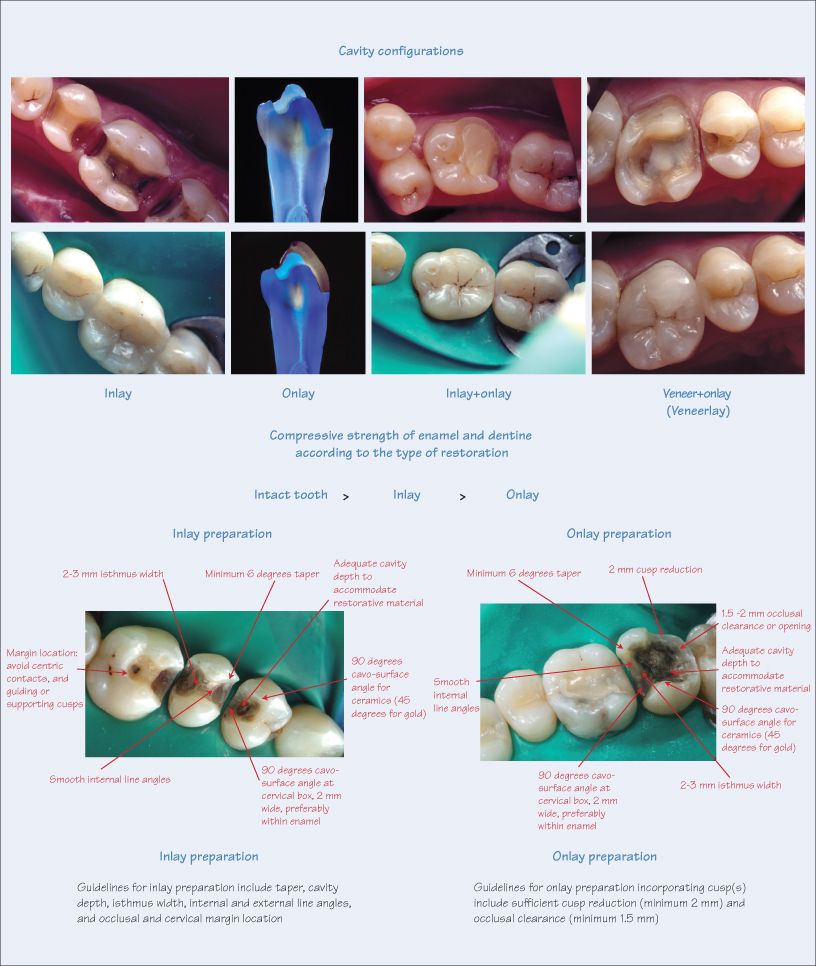 35 Preparation for inlays and onlays Pocket Dentistry