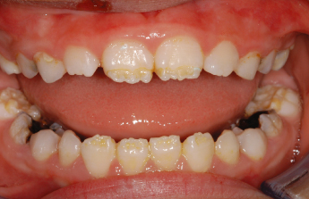 enamel hypoplasia