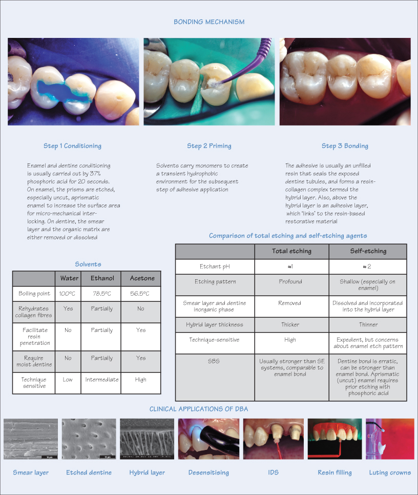 Bonding Agents In Dentistry