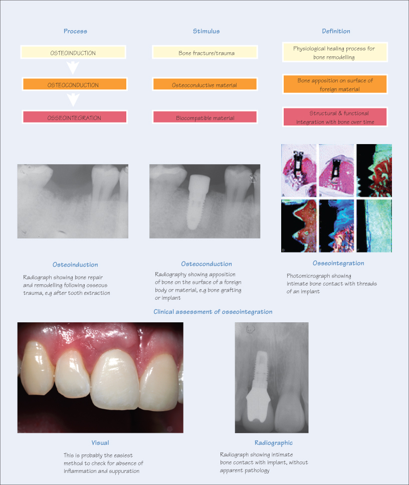 48 Osseointegration Pocket Dentistry