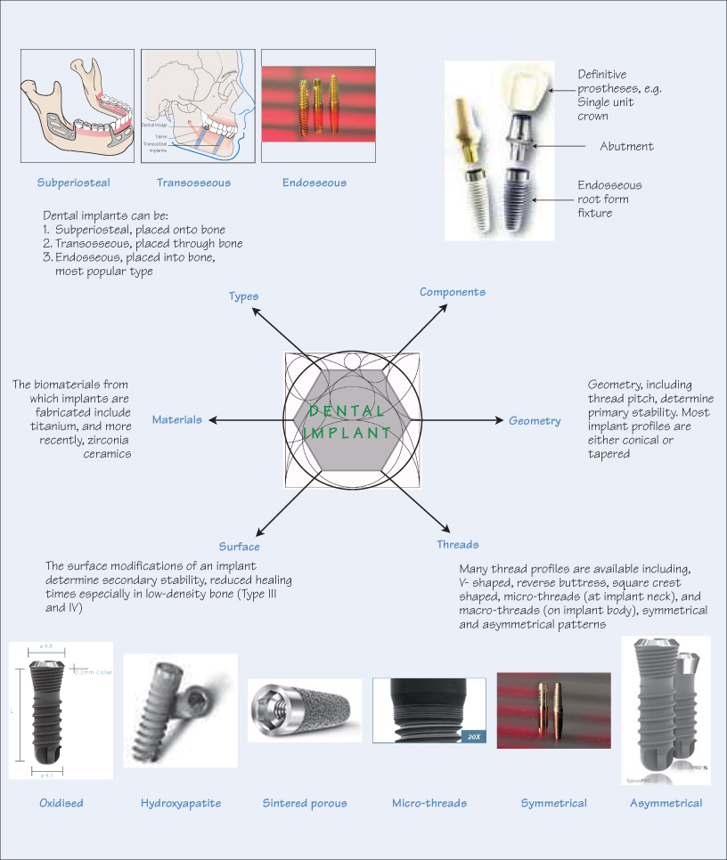 tooth implant types