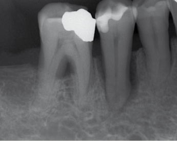 bone spicules after tooth extraction