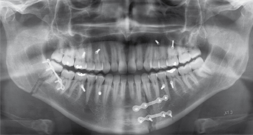 tooth fragments left after extraction