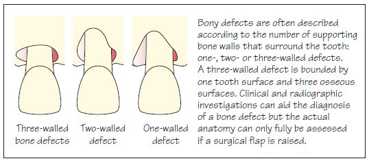 27: Bone Defects and Furcation Lesions | Pocket Dentistry
