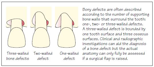 27 Bone Defects And Furcation Lesions Pocket Dentistry