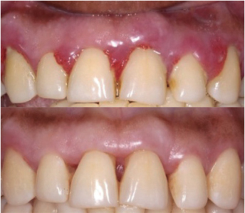 Teeth scaling meaning