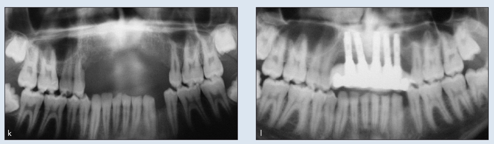 Alveolar Distraction Osteogenesis Pocket Dentistry