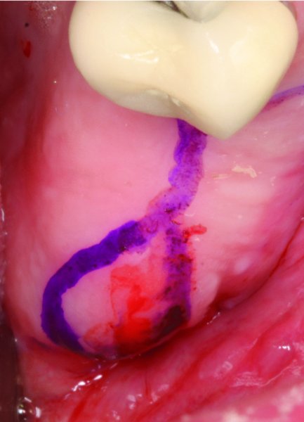 54: Posterior Iliac Crest Bone Graft