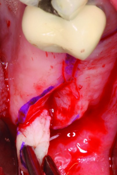 54: Posterior Iliac Crest Bone Graft