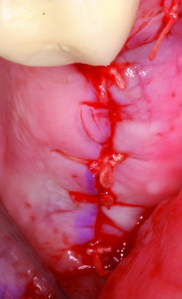 54: Posterior Iliac Crest Bone Graft