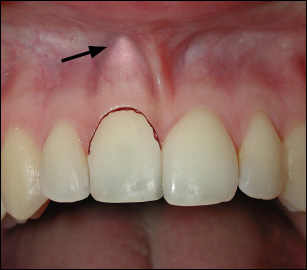 tooth luxation