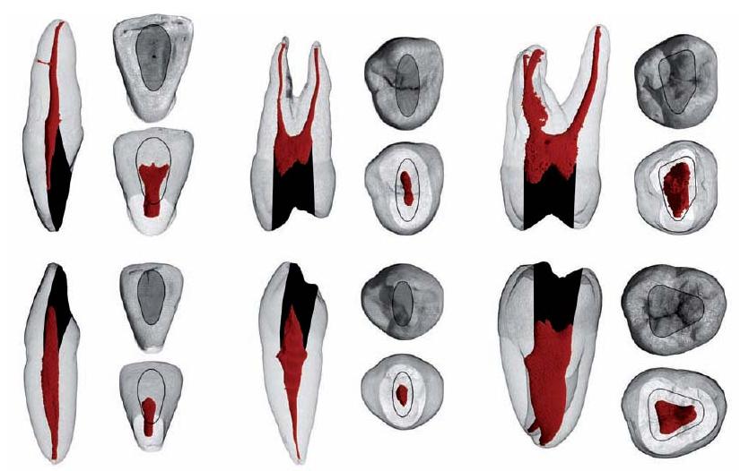 11: Root canal instrumentation | Pocket Dentistry