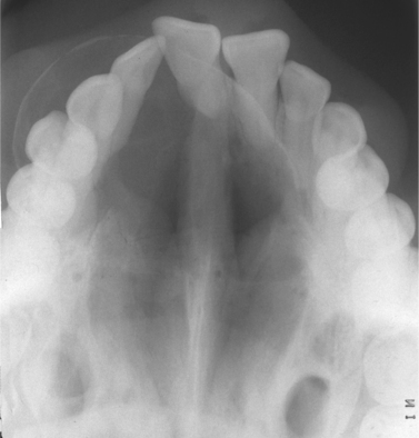 8. Odontogenic tumours and tumour-like lesions of the jaws | Pocket ...