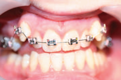 11: TOOTH ALIGNMENT WITH ORTHODONTIC BRACES | Pocket Dentistry