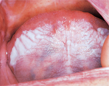 sublingual keratosis ventral involving uniformly