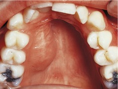 Bumps On Roof Of Mouth