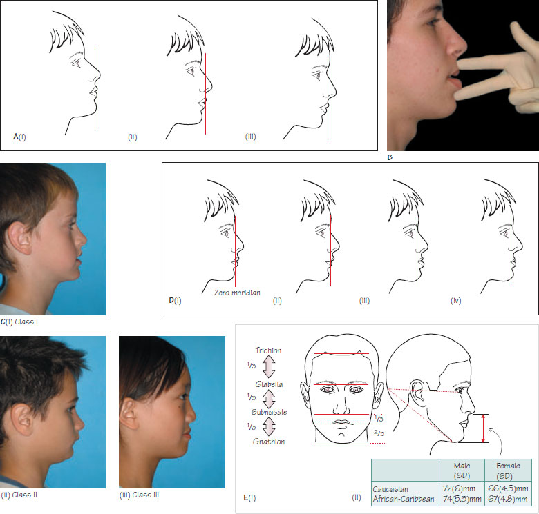 Illustrates Class I, Class II, and Class III facial skeletal profiles.