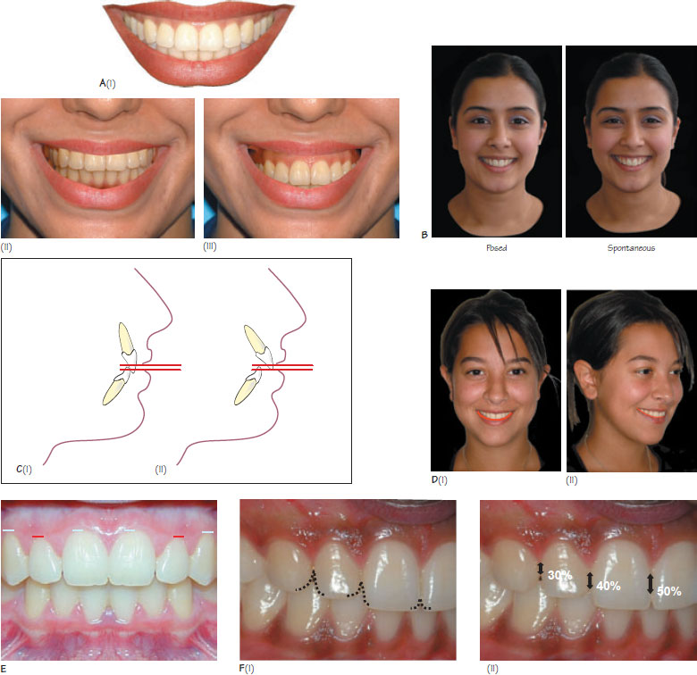 17-smile-analysis-pocket-dentistry