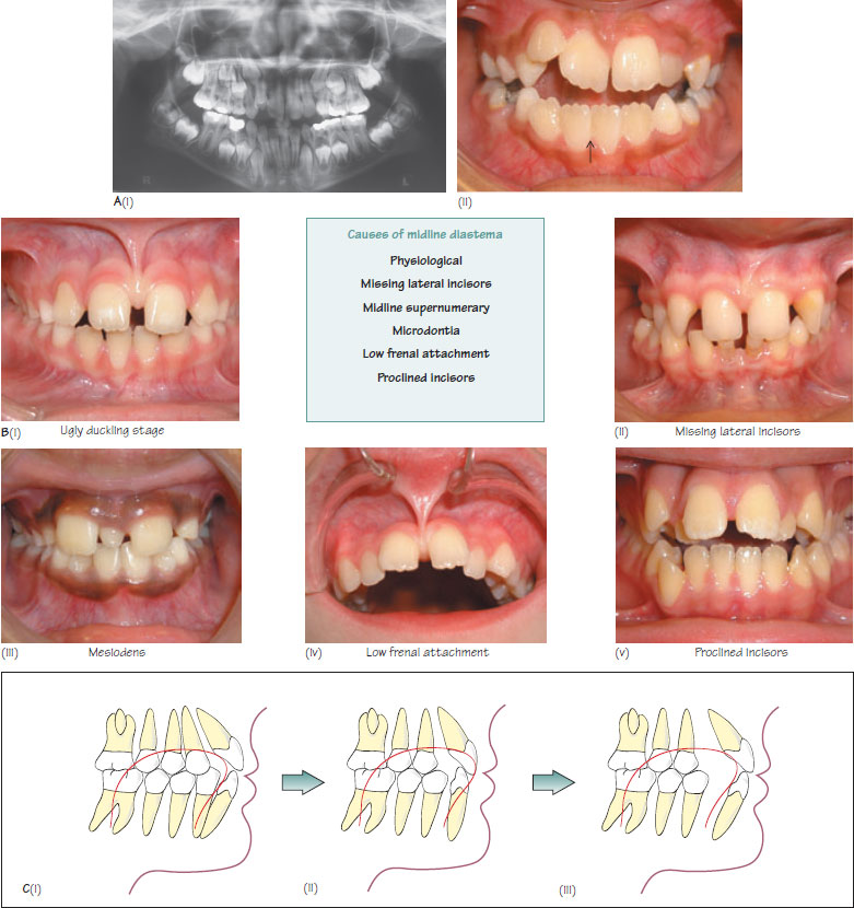 22 Class II division 1 malocclusion