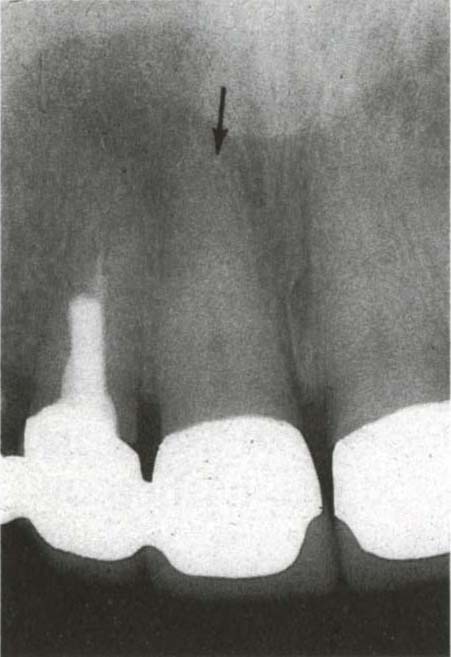 bone splinters after tooth extraction