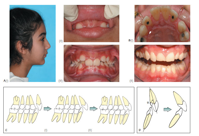 23 Class II division 2 malocclusion