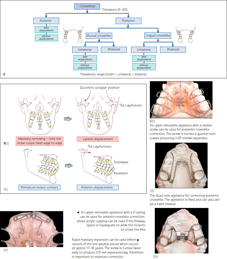 Bite Classifications – ClearCorrect Support