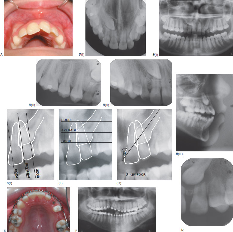 32 Impacted maxillary canines