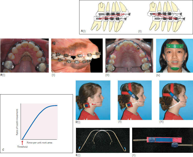 23 Class II division 2 malocclusion