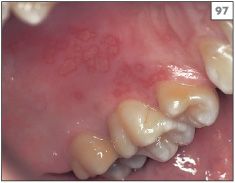 herpetic gingivostomatitis palate