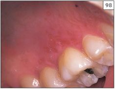 herpetic gingivostomatitis palate