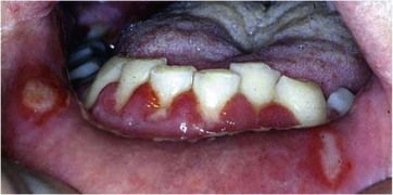 5: Is it periodontal disease?: Other conditions affecting the ...