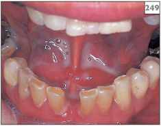 6 Swelling Pocket Dentistry