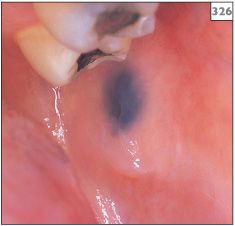 Extensive amalgam tattoo amalgam pigmentation on the palatal mucosa a  short case report