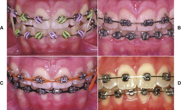Orthodontic Wire - an overview