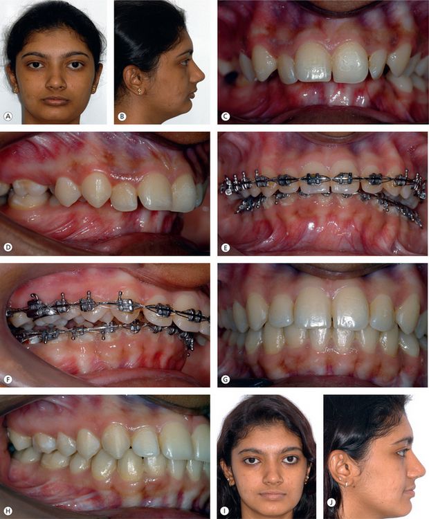 6 Surgical orthodontics Pocket Dentistry