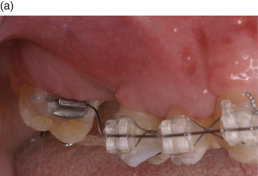 25 The oral cavity and related structures | Pocket Dentistry