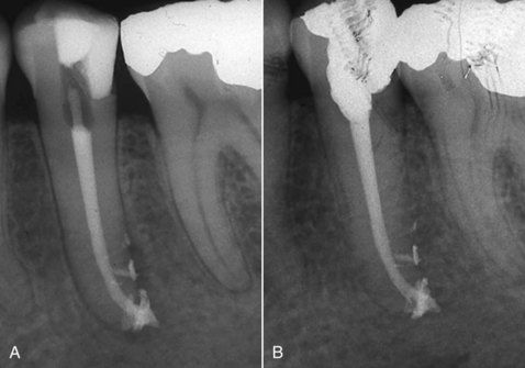 Tooth 25 root canal