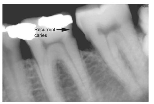 secondary caries