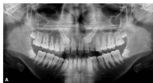 18 Modalities Of Management Of Impacted Canine Pocket Dentistry