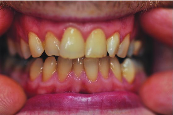 teeth calculus black wiki