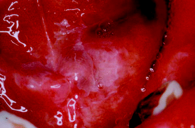 tongue diagnostic methods hyperkeratosis lateral ventral oral