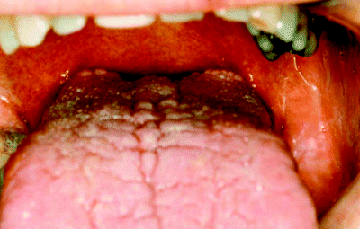 calculus buildup on bar of my tongue ring