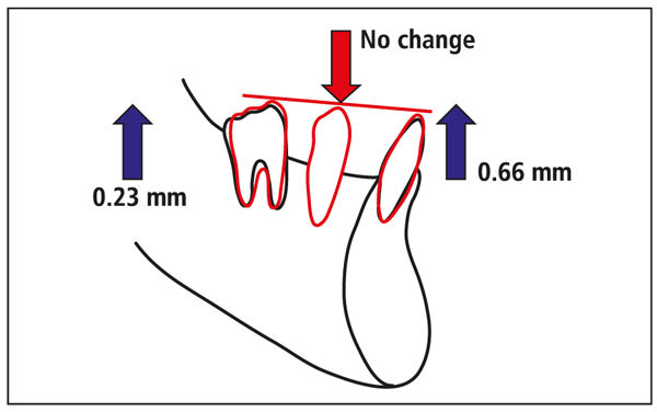 What does a reverse curve wire do for braces? 1 Month Check Up