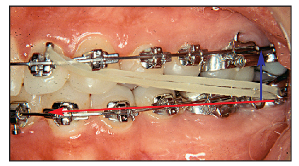 How Orthodontic Elastic Bands Work - Belmar Orthodontics