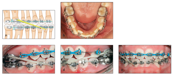 How Orthodontic Elastic Bands Work - Belmar Orthodontics