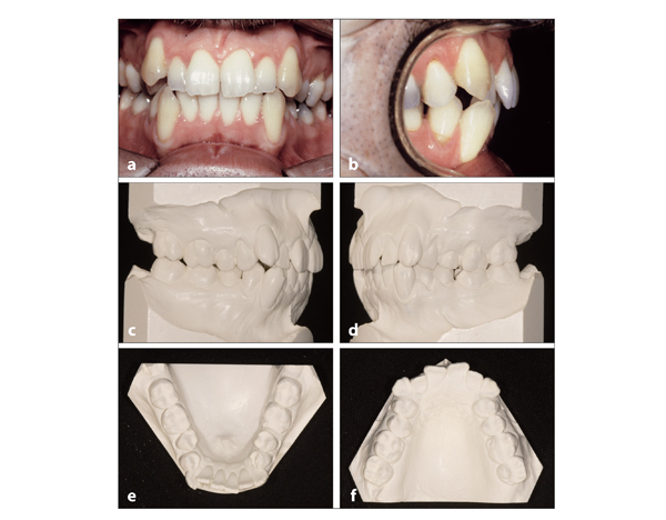 12 Class II, Division 2 Malocclusions