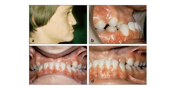 13-class-iii-malocclusions-pocket-dentistry