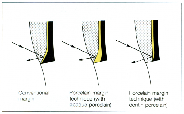 Pfm Crown Prep Dimensions